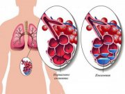 7 признаков пневмонии, о которых должен знать каждый