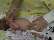 В Свердловской области начали проводить лапароскопические операции двенадцатиперстной кишки новорожденным