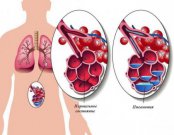 7 признаков пневмонии, о которых должен знать каждый